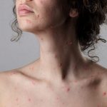 Cuanto dura la varicela en adultos