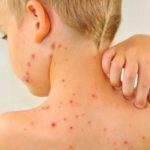 Cuanto dura la varicela en niños